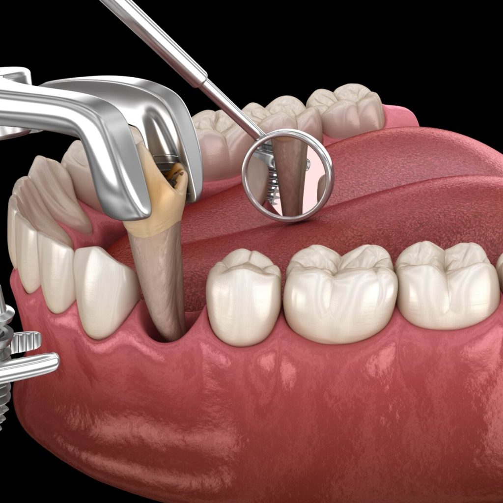 Tooth Extraction