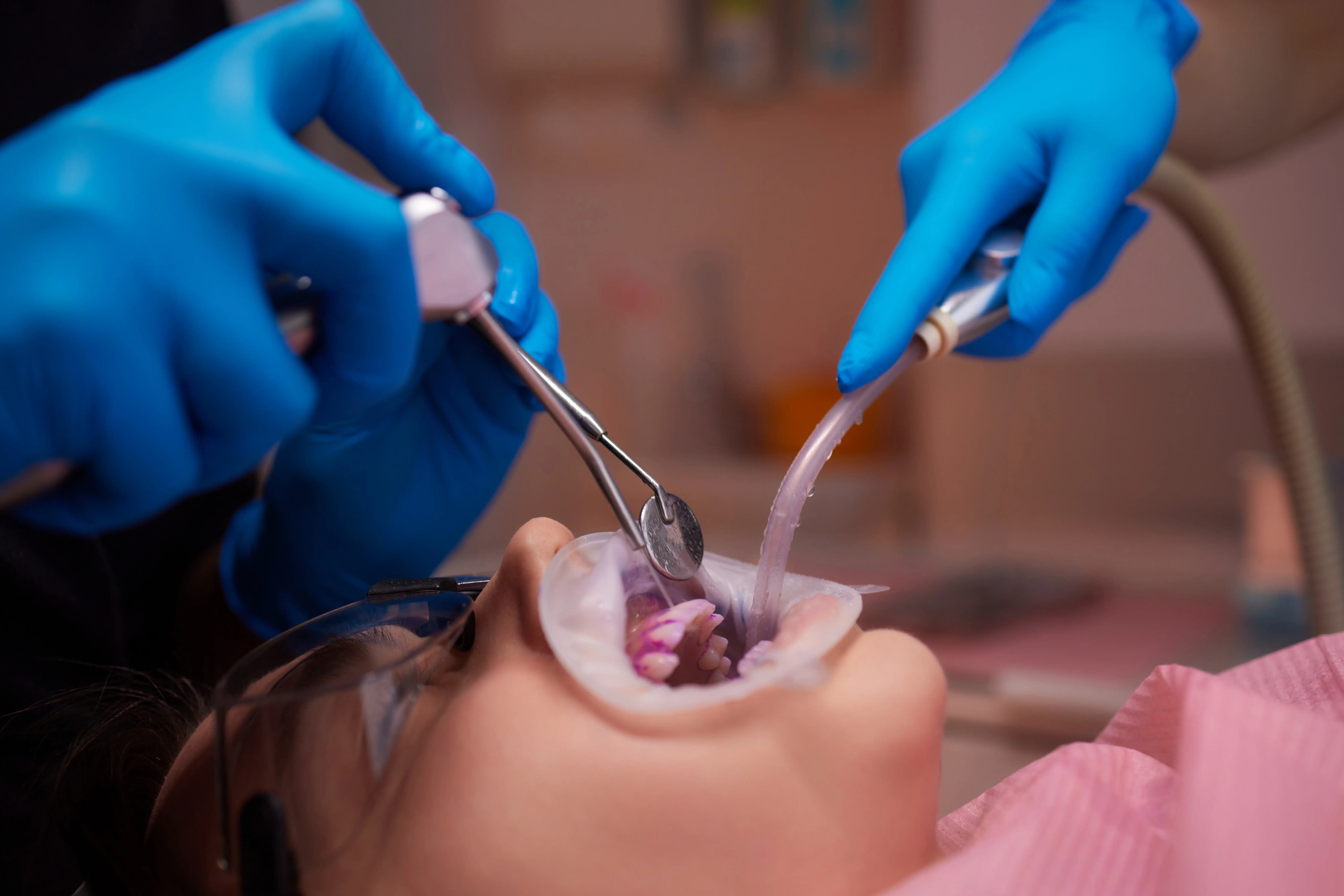 How long Can You Delay Wisdom Tooth Extraction?